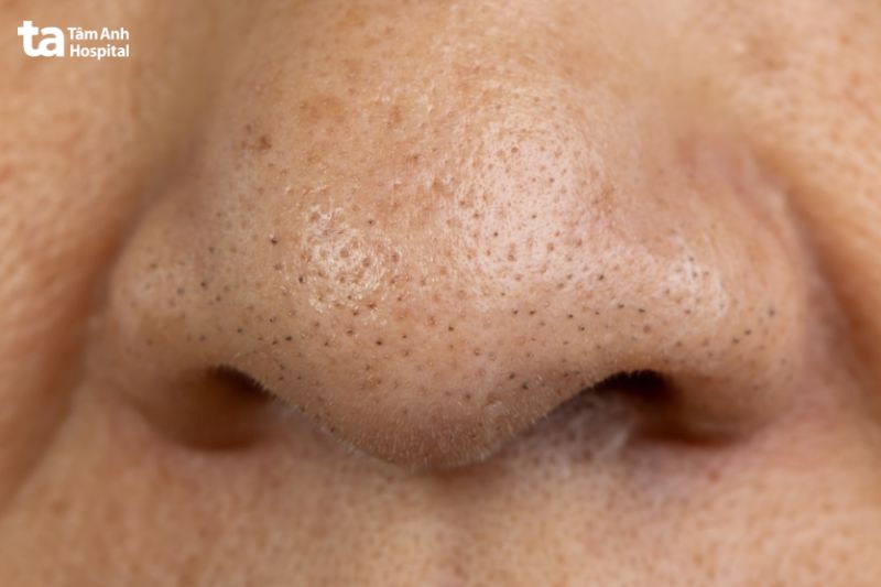 Nguyên nhân lỗ chân lông to - minh họa từ Tâm Anh Hospital