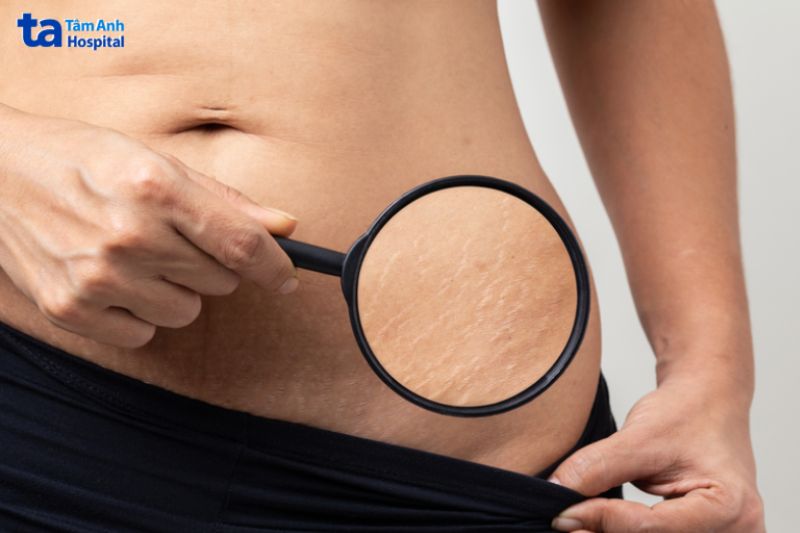 Phân loại vết rạn da sau sinh theo màu sắc và giai đoạn