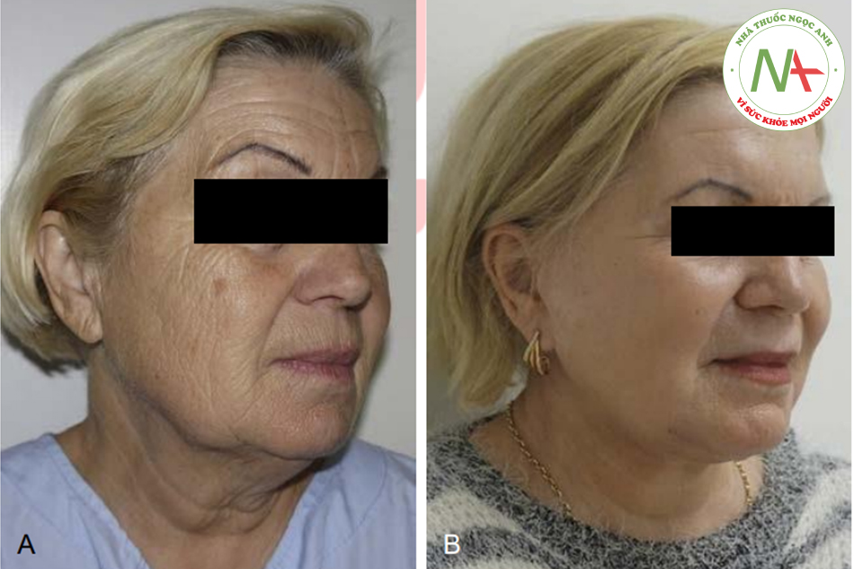 Mô hình PEEL phát triển ý tưởng trong body paragraph