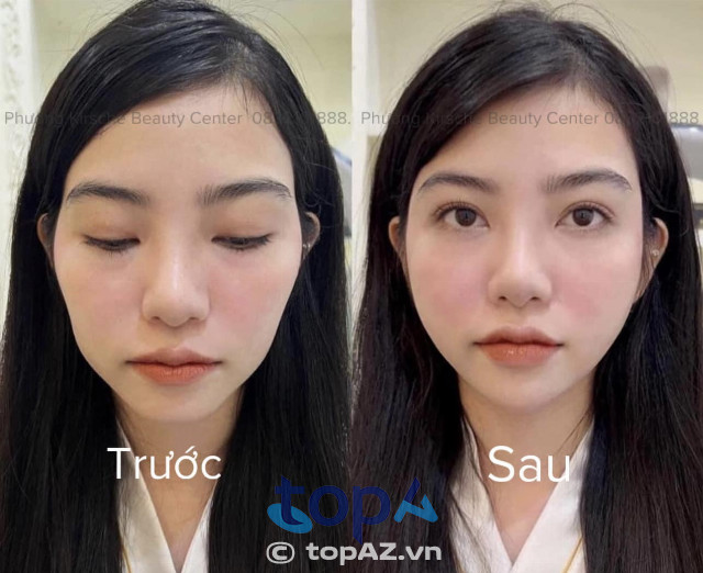 Trẻ hóa da không dao kéo - filler, botox và chỉ treo tại phòng khám Linh Anh